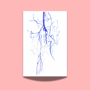 Buerger Disease - Thromboangiitis Obliterans CT Angio