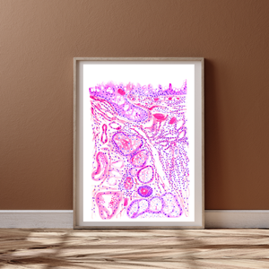 Chronic Conjunctivitis Histopathology Art Print