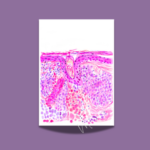 Basal Cell Carcinoma Skin Histopathology Artwork