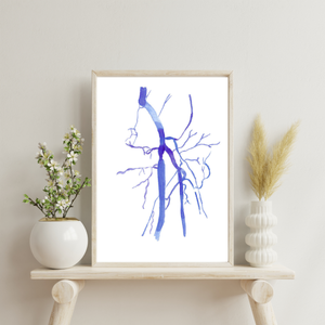 Femoral Artery Occlusion DSA Watercolor Anatomy Art Print