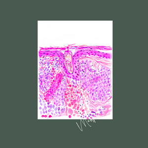 Basal Cell Carcinoma Skin Histopathology Artwork