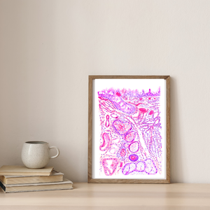 Chronic Conjunctivitis Histopathology Art Print