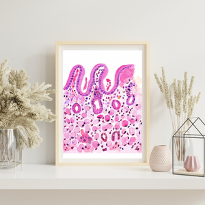 Stomach Signet Ring Carcinoma Histopathology Art