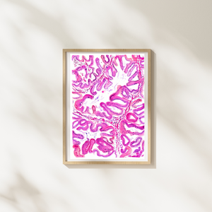 Endometrial Cancer Art Print