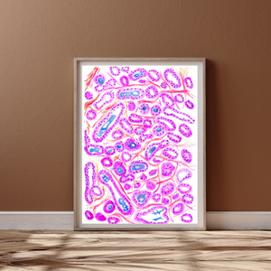 Prostate Adenocarcinoma Uropathology Art Print