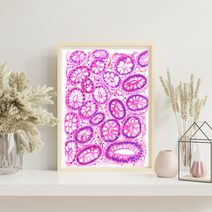Colon Polyp - Tubular Adenoma Histopathology Art