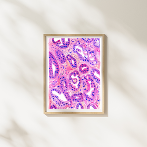 Ovarian Cancer Histopathology Art