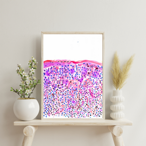 Melanoma Watercolor Art Print