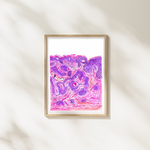 Vulvar Carcinoma Gynecological Pathology Art Print