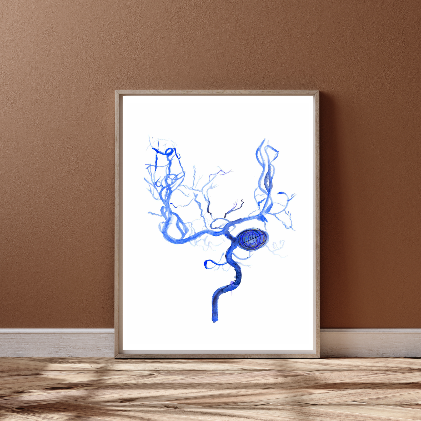 Brain Aneurysm Coiling Art Print