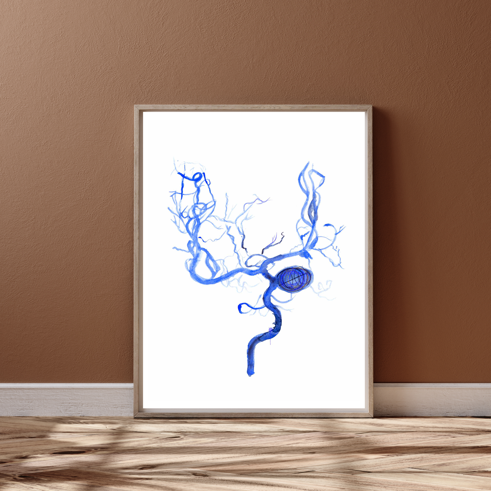 Brain Aneurysm Coiling Art Print