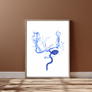 Brain Aneurysm Coiling Art Print