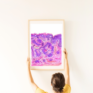 Vulvar Carcinoma Gynecological Pathology Art Print