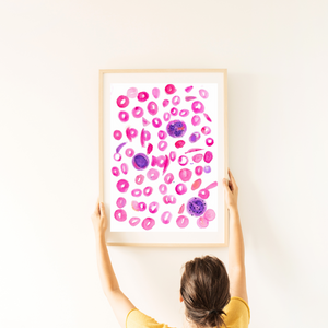 Sickle Cell Anemia Art Print