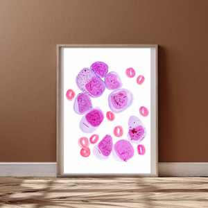 AML Bone Marrow Hisopathology Art