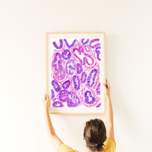 Ovarian Cancer Histopathology Art
