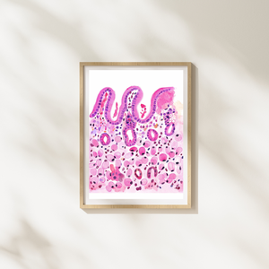 Stomach Signet Ring Carcinoma Histopathology Art