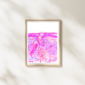 Basal Cell Carcinoma Skin Histopathology Artwork