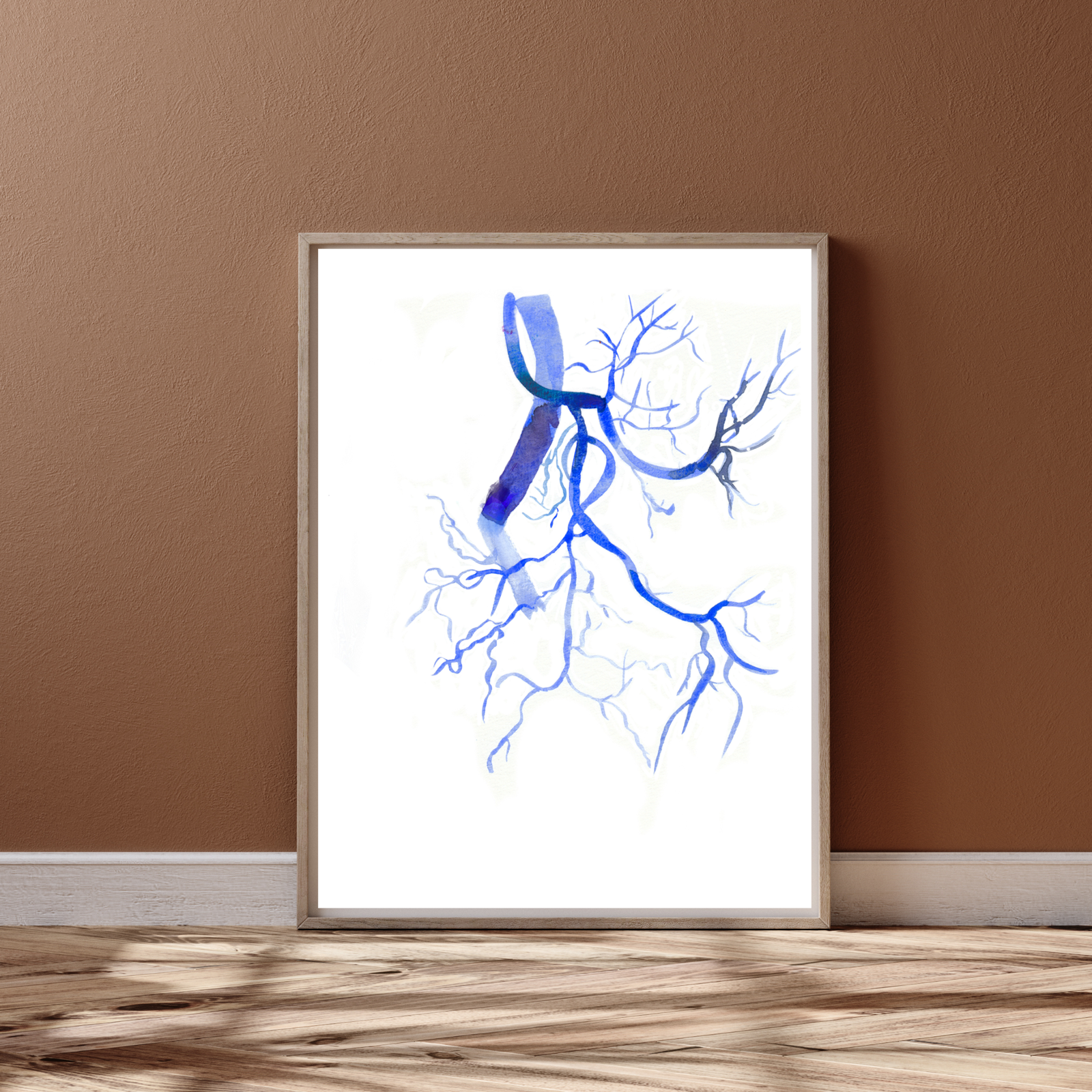 Prostatic Artery Embolization Watercolor Art print