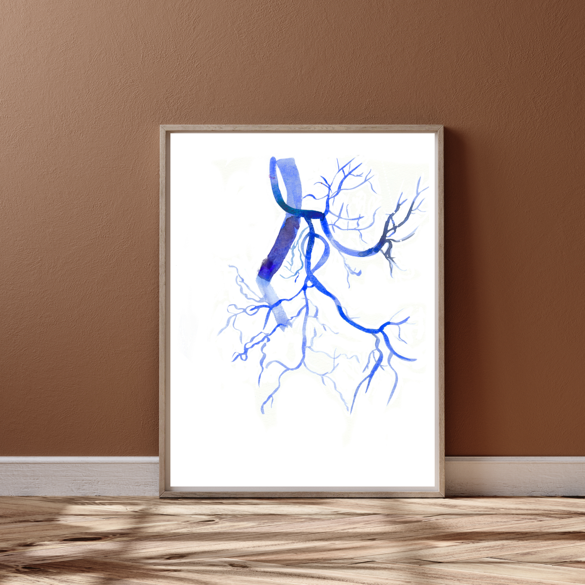 Prostatic Artery Embolization Watercolor Art print
