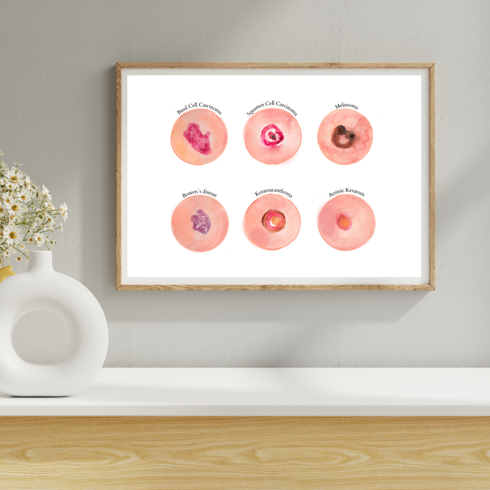 Skin Tumour Watercolor Art