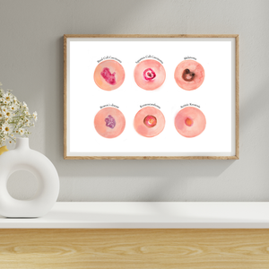 Skin Tumour Watercolor Art