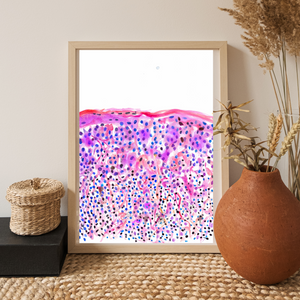 Melanoma Watercolor Art Print