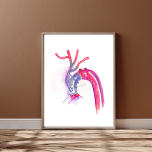 Aorta Aneurysm Repair Art Print