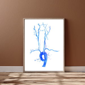 Carotid Angiography Post Stenting Watercolor Art Print
