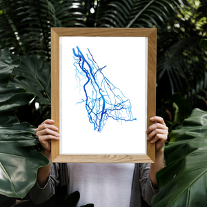 Upper Limb DSA, Vascular Surgery Radiology Art Print
