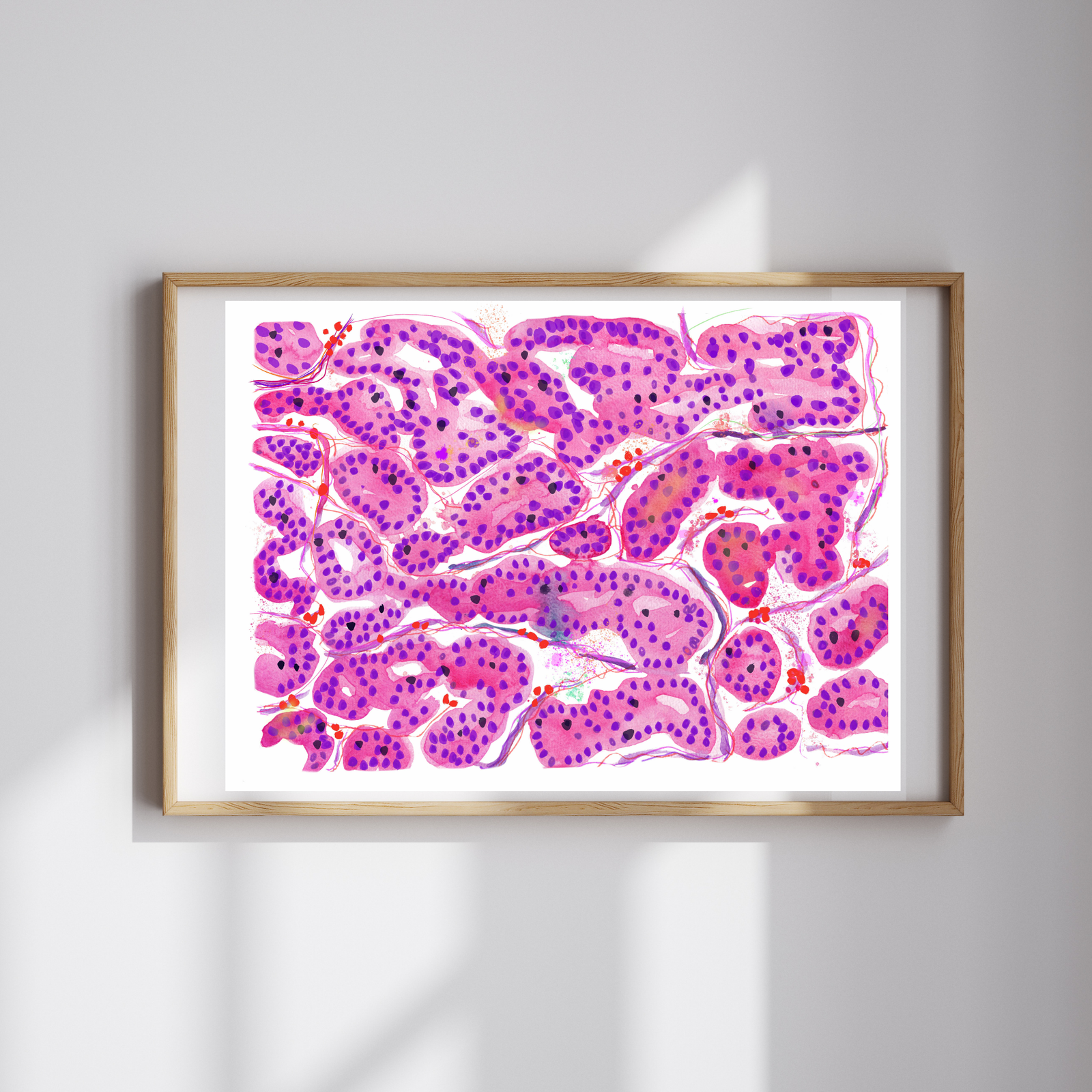 Hepatocellular Carcinoma Histopathology Art