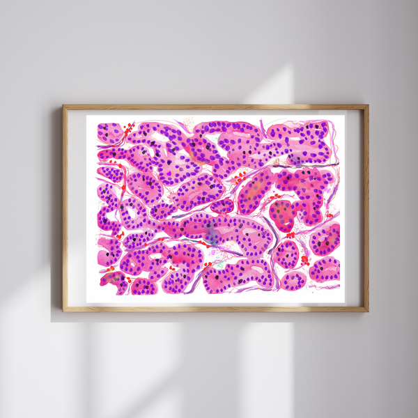 Hepatocellular Carcinoma Histopathology Art - medpapers