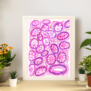 Colon Polyp - Tubular Adenoma Histopathology Art