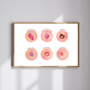 Skin Tumour Watercolor Art