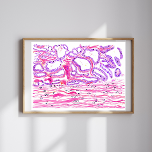 Breast Cancer Histopathology Art - Papillary Carcinoma