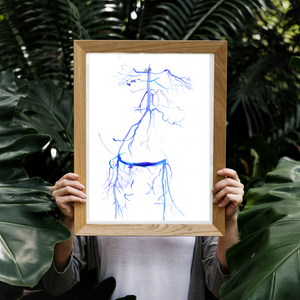 Crossover iliac artery bypass