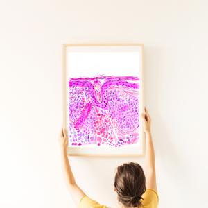 Basal Cell Carcinoma Skin Histopathology Artwork