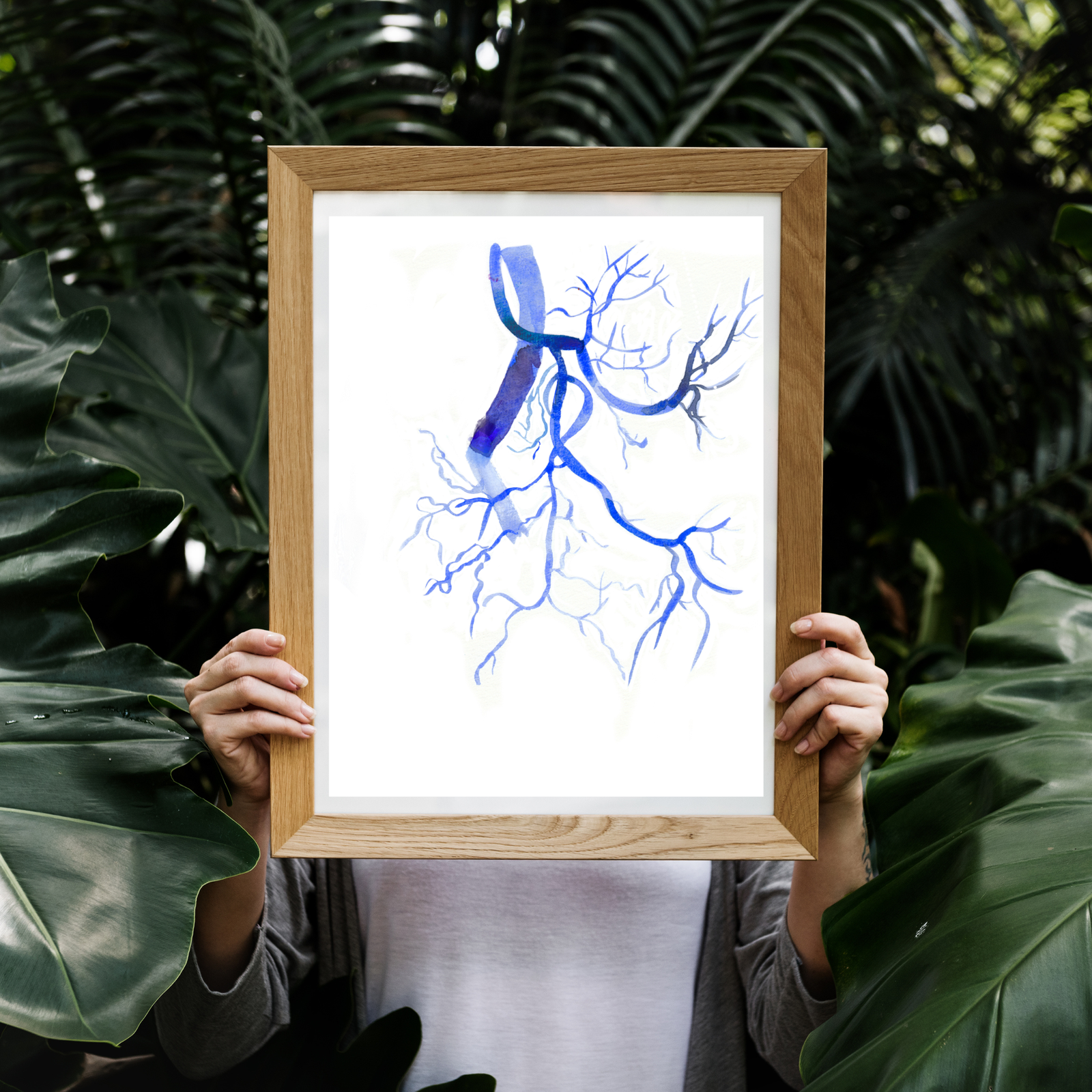 Prostatic Artery Embolization Watercolor Art print