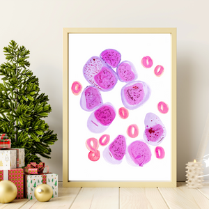 AML Bone Marrow Hisopathology Art