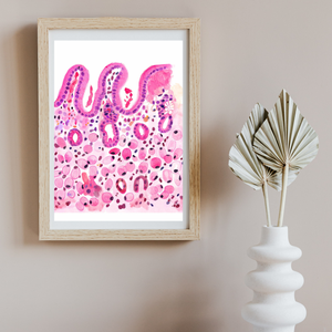 Stomach Signet Ring Carcinoma Histopathology Art