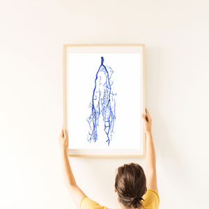 Lover Limb Varicose Vein Venography Art