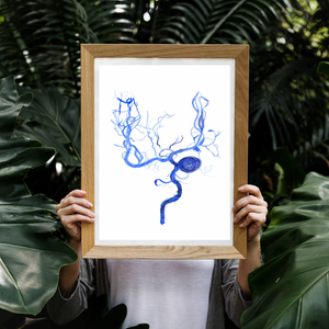 Brain Aneurysm Coiling Art Print