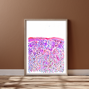 Melanoma Watercolor Art Print