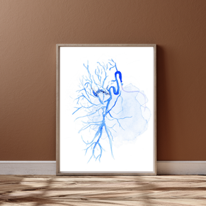 Bronchial Artery Embolization Interventional Radiology Art Print