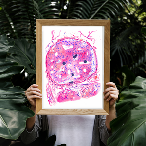 Breast Cancer Histopathology Art - DCIS