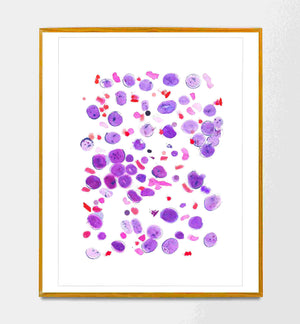 Acute Lymphoblastic Leukemia Hematooncology Art Print