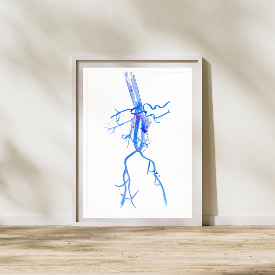 Aorta Aneurysm Watercolor Art Print