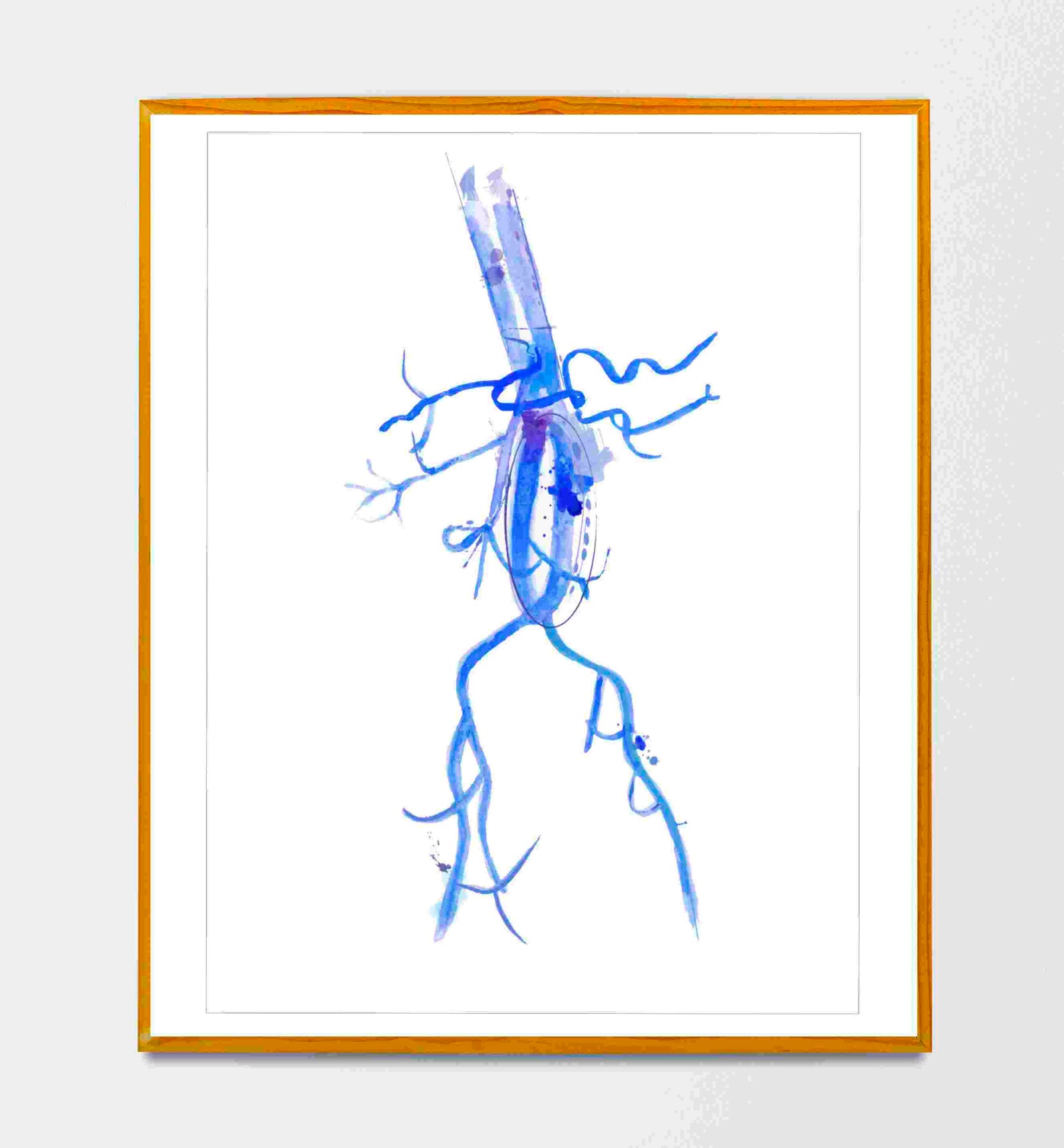 Aorta Aneurysm Watercolor Art Print