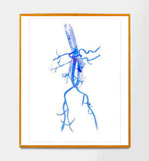 aorta aneurysm watercolor art print