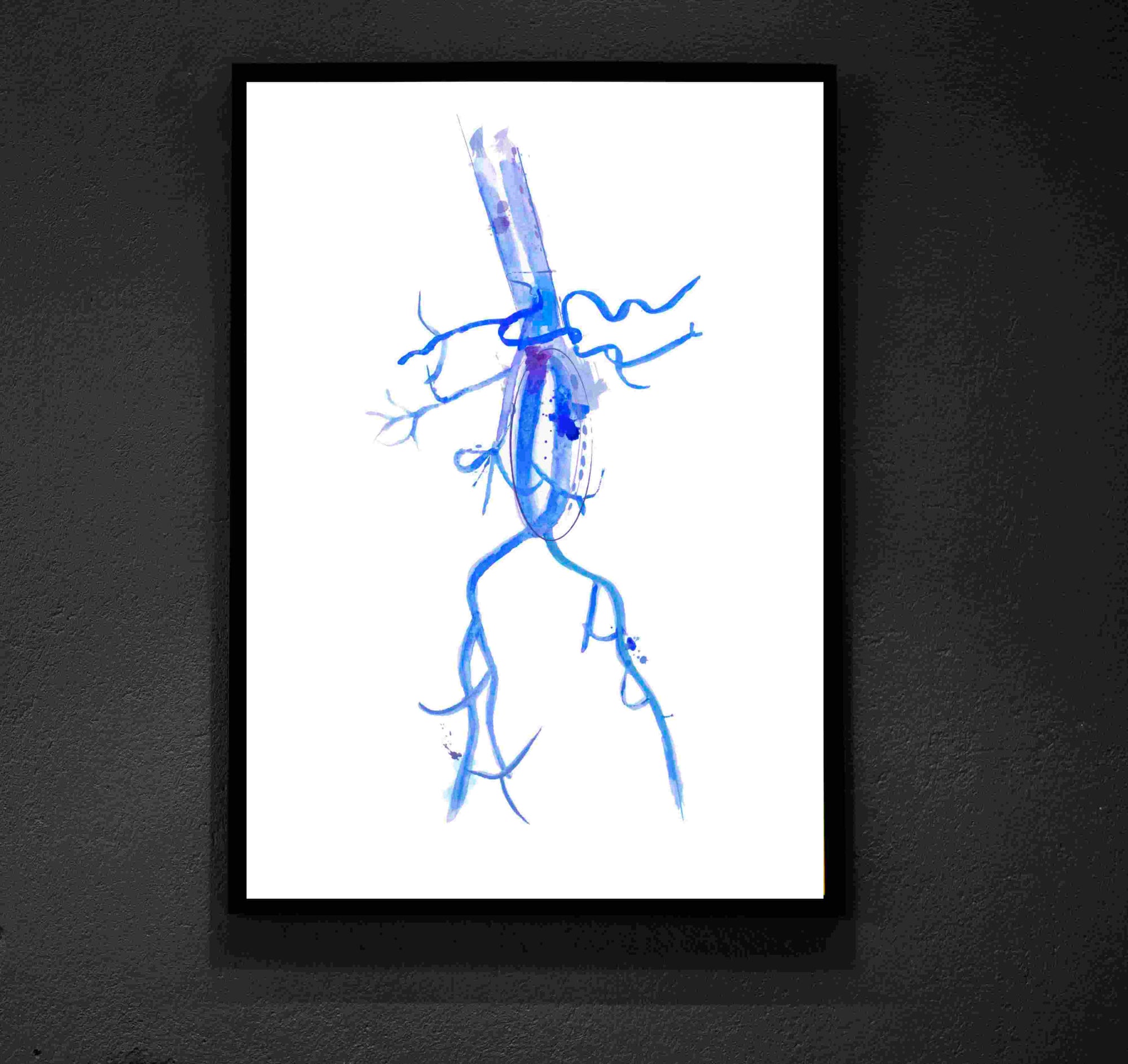 aorta aneurysm watercolor art print